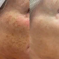 پوستی بدون لک وجوش واسکار