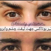 خدمات تخصصی تزریق بوتاکس فیلر بانوان و آقایون|خدمات آرایشگری و زیبایی|بیرجند, |دیوار