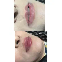 ژل و بوتاکس