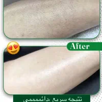 جشنواره فوق العاده لیزر و لاغری با دستگاه کرایو|خدمات آرایشگری و زیبایی|بروجرد, |دیوار