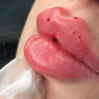 تخفیف ویژه ژل لب فیلرگونه آنزیمprpبوتاکس فیلربادی
