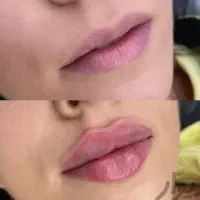تزریق ژل و بوتاکس|خدمات آرایشگری و زیبایی|اصفهان, گلزار|دیوار