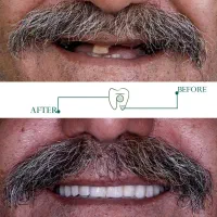 ایمپلنت دیجیتال اقساطی بدون سود تحت بیهوشی|خدمات آرایشگری و زیبایی|مرودشت, ژیان|دیوار