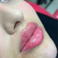 ژل،بوتاکس،کاشتمو،ساکشن غبغب،جوانساز