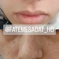 حذف دائمی کک و مک|خدمات آرایشگری و زیبایی|تربت جام, المهدی|دیوار