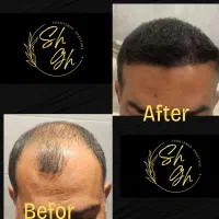 کاشتمو تضمینی  آقایان در شیراز