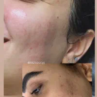 آنالیز رایگان دستگاهی پوست ومشاوره تعداد محدود