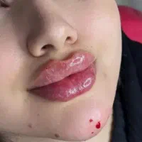 بوتاکس۹۹۰ ژل۸۹۰  مزوتراپی با تخفیف ویژه