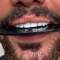 دنداپزشکی کامپوزیت لمینیت