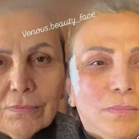 جشنواره50%تزریق ژل بوتاکس لیفت مزو لیزر توسط پزشک