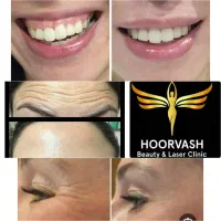 بوتاکس فیلر مزو نخ پی آر پی چربی جوانسازی بدون عمل|خدمات آرایشگری و زیبایی|کرج, گلشهر|دیوار