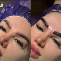 کاشت ابروی طبیعی ومواقساط دومرحله ای ۹۵۰۰