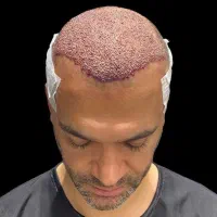 کاشت مو و ابروی طبیعی مزو و پی آرپی جلوگیری ریش مو|خدمات آرایشگری و زیبایی|تبریز, |دیوار