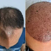 کاشت مو و ابرو|خدمات آرایشگری و زیبایی|تبریز, |دیوار