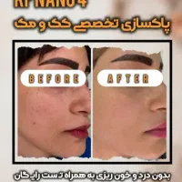 تخفیف درمان حرفه‌ای لک و کک‌ومک و مزو تراپی