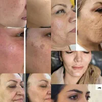 مزوتراپی و بوتاکس