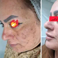 فیشال تخصصی  ریموو کک مک و مزونیدلینگ رفع لک کک مک