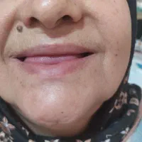 دندان مصنوعی/قالب گیری در منزل /نایت گارد