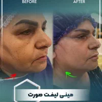 بلفارو/ لیفت صورت و ابرو/غبغب/تزریق چربی با تخفیف|خدمات آرایشگری و زیبایی|مشهد, سجاد شهر|دیوار