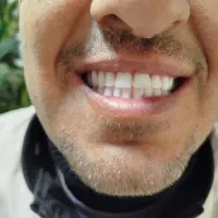 ساخت کامل پروتز متحرک ( دندان مصنوعی )