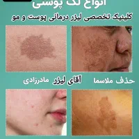 خال صورت/لکه های پوستی/لیزرموسفید/ریموتتو/بوتاکس|خدمات آرایشگری و زیبایی|نجف‌آباد, بازار|دیوار