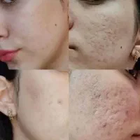 آنالیز ودرمان ریشه ای علت جوش ولک واسکار