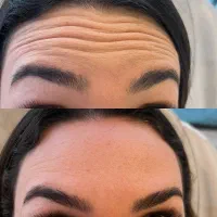جشنواره خدمات زیبایی (تزریق فیلر و بوتاکس)