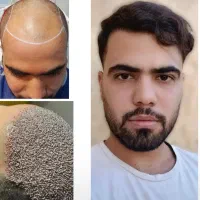 کاشت مو با ضمانت نامه کتبی