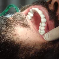 کامپوزیت، ترمیم،  پالیش، اعصاب کشی