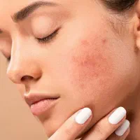 راهنمایی از، بین بردن جای جوش و اسکار