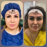 کاشت مو و ابرو طبیعی و متقارن و اصولی در یزد|خدمات آرایشگری و زیبایی|یزد, |دیوار