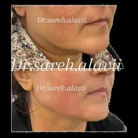 جشنواره هایفوتراپی به مدت محدود توسط پزشک