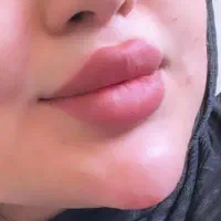 ژل بوتاکس خالبرداری فشیال زگیل تناسلی مطب زیبایی|خدمات آرایشگری و زیبایی|تبریز, |دیوار