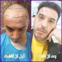 پیوند مو و ابرو در تهران در کلینیک معتبر|خدمات آرایشگری و زیبایی|کاشان, امیرکبیر|دیوار