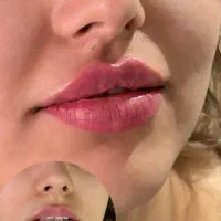 ژل وبوتاکس