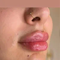 ژل و بوتاکس بهترین متریال و خدمات