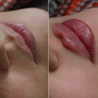 ژل بوتاکس تزریق مزو پی آر پی(سابسیژن)فیلر آلت