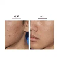 میکرودرم خانگی مدل 3w|آرایشی، بهداشتی، درمانی|تهران, سید خندان (جلفا)|دیوار