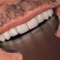 دندانپزشکی ایمپلنت کامپوزیت لمینیت روکش دندان|خدمات آرایشگری و زیبایی|تبریز, |دیوار