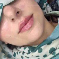 ژل بوتاکس فیلر ،خالبرداری، آموزش فیشیال وپاکسازی|خدمات آرایشگری و زیبایی|شیراز, منطقه هوایی شهید دوران|دیوار