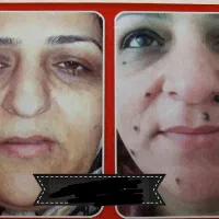 مدل ، برداشتن خال و زگیل و میخچه|خدمات آرایشگری و زیبایی|سقز, |دیوار