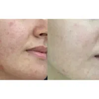 سفید کننده تضمینی اقتصادی رفع لک و جای جوش بوشهر