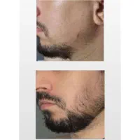 خداحافظی با جاهای خالی ریش