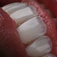 کامپوزیت دندان لمینت روکش طلا اقساط|خدمات آرایشگری و زیبایی|تهران, دریاچه شهدای خلیج فارس|دیوار