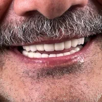 لمینت مترحک دندان|آرایشی، بهداشتی، درمانی|اهواز, آریاشهر|دیوار