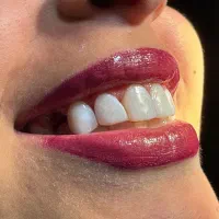 ایمپلنت/زیبایی/لمینیت/روکش