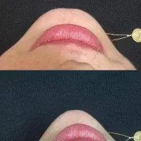 بمب تخفیف ژل و بوتاکس|خدمات آرایشگری و زیبایی|بندر امام خمینی, |دیوار