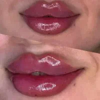 انجام ژل وبوتاکس وخط اخم ....