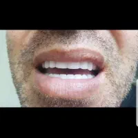 دندان مصنوعی بیمه (اقساط)(لمینت) ارتودنسی پیروزی|خدمات زیبایی و سلامت|تهران, نیروی هوایی (پیروزی)|دیوار