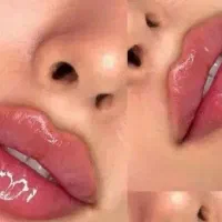 تزریق فیلر/مزو ژل جوانساز/بوتاکس
